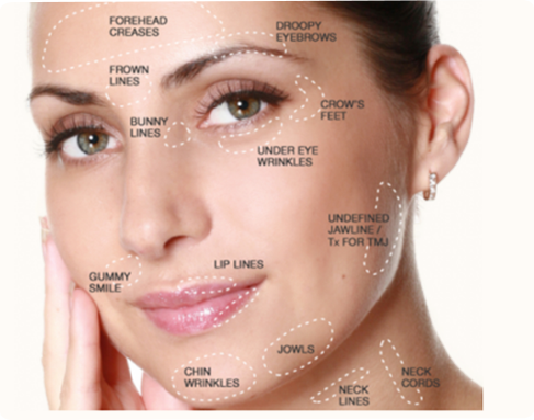 Botox, Dysport, Juvederm, Restylane