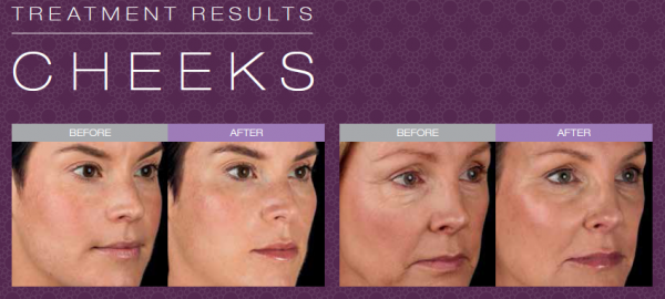 Juvederm to cheeks