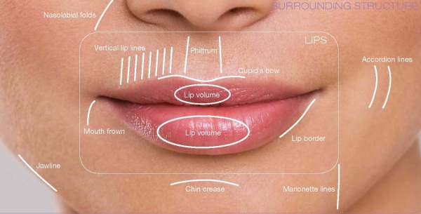 Dermal filler for Cupid's bow - Cosmetic Connection