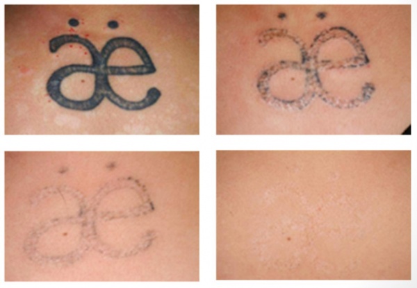 Philadelphia Laser Tattoo Removal  InkAway Laser Tattoo Removal