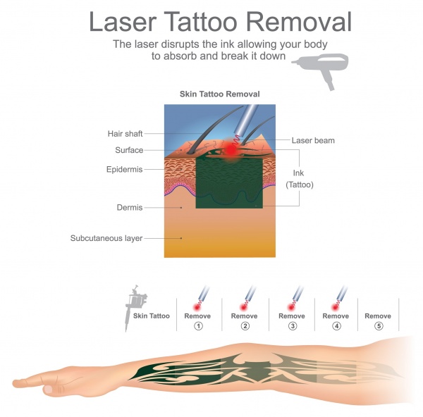 tattoo laser