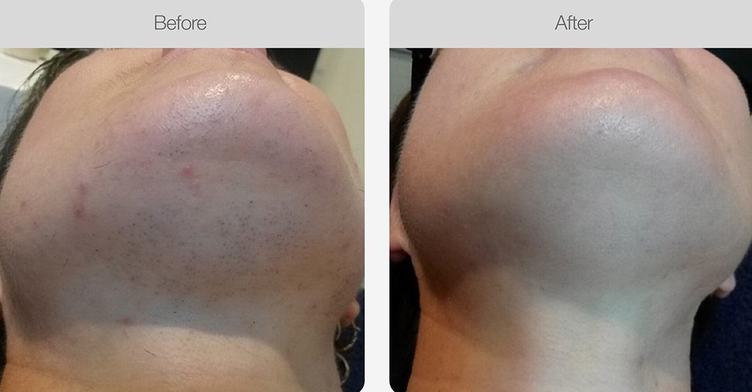IPL hair removal chin face